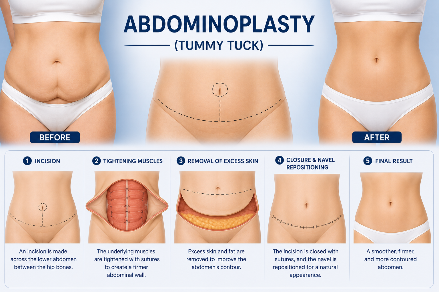 Abdominoplasty tummy tuck cosmetic surgery Regal Hospital Bangalore