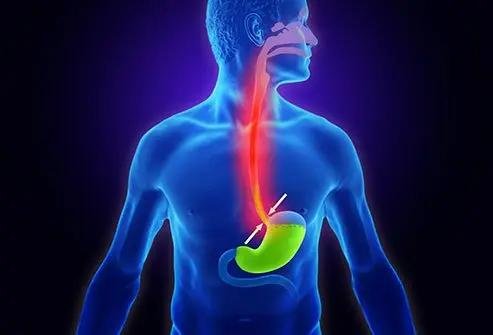 Gastrointestinal surgery Anti-reflux fundoplication surgery for GERD Regal Hospital North Bangalore
