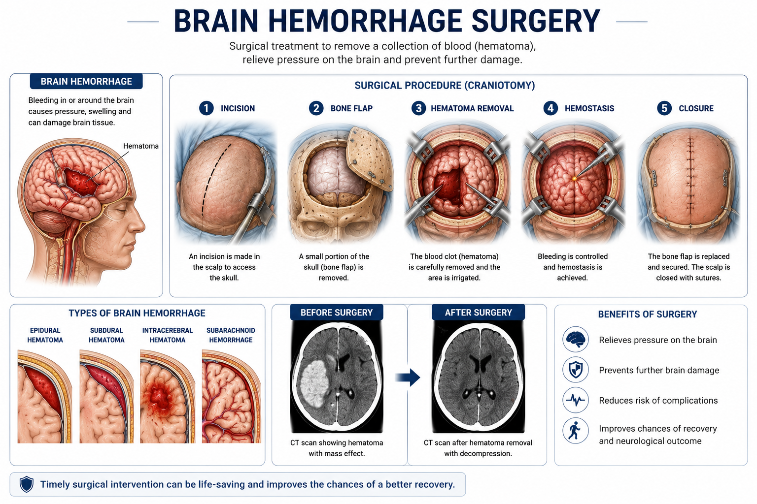 Brain hemorrhage evacuation emergency neurosurgery Regal Hospital North Bangalore