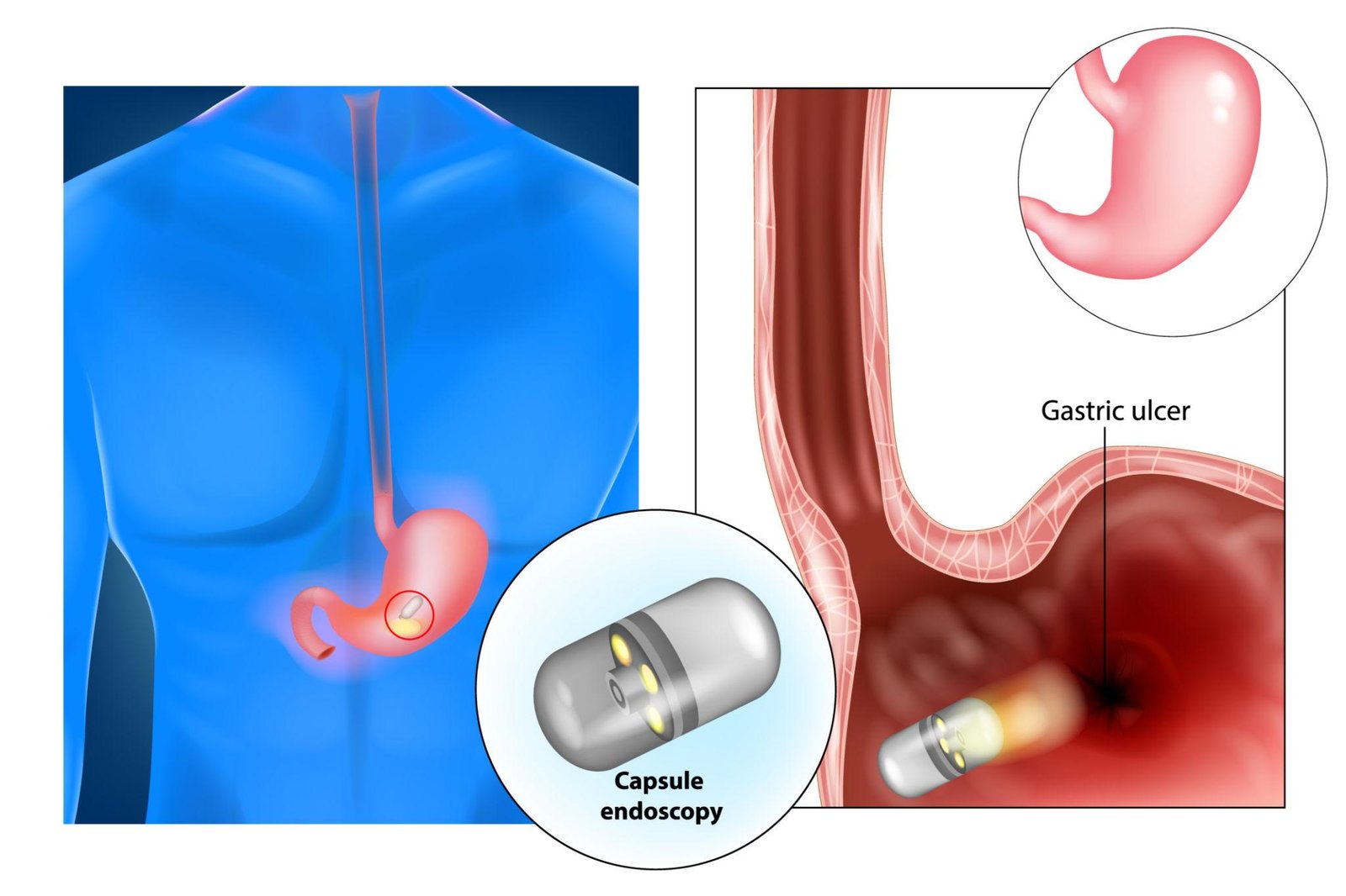 Gastrointestinal surgery Capsule endoscopy enteroscopy small bowel Regal Hospital Bangalore
