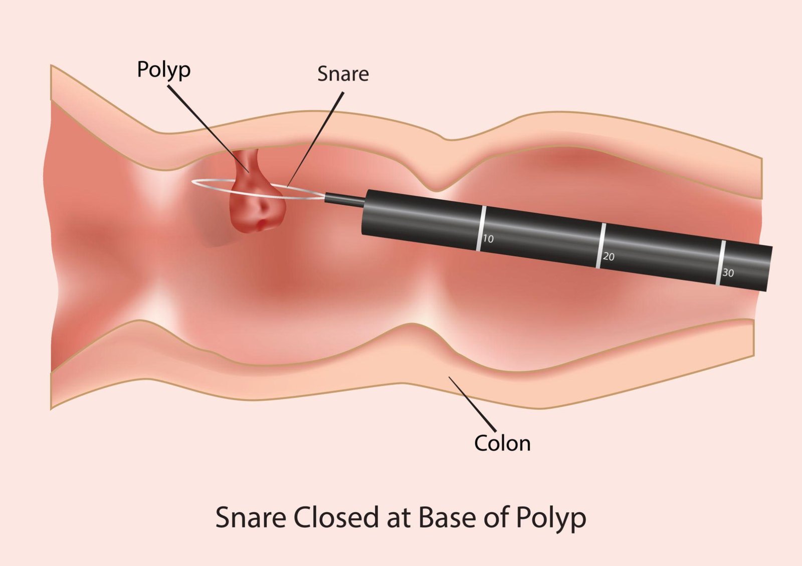 Gastrointestinal surgery Colonoscopy polypectomy GI screening Regal Hospital Bangalore