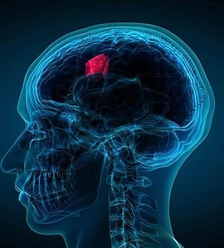Craniotomy for brain tumour surgery Regal Hospital Bangalore