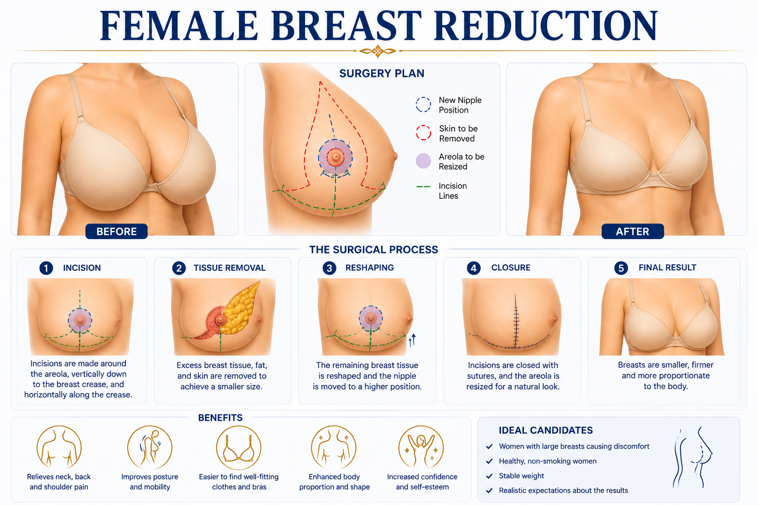 Female breast reduction cosmetic surgery Regal Hospital Bangalore