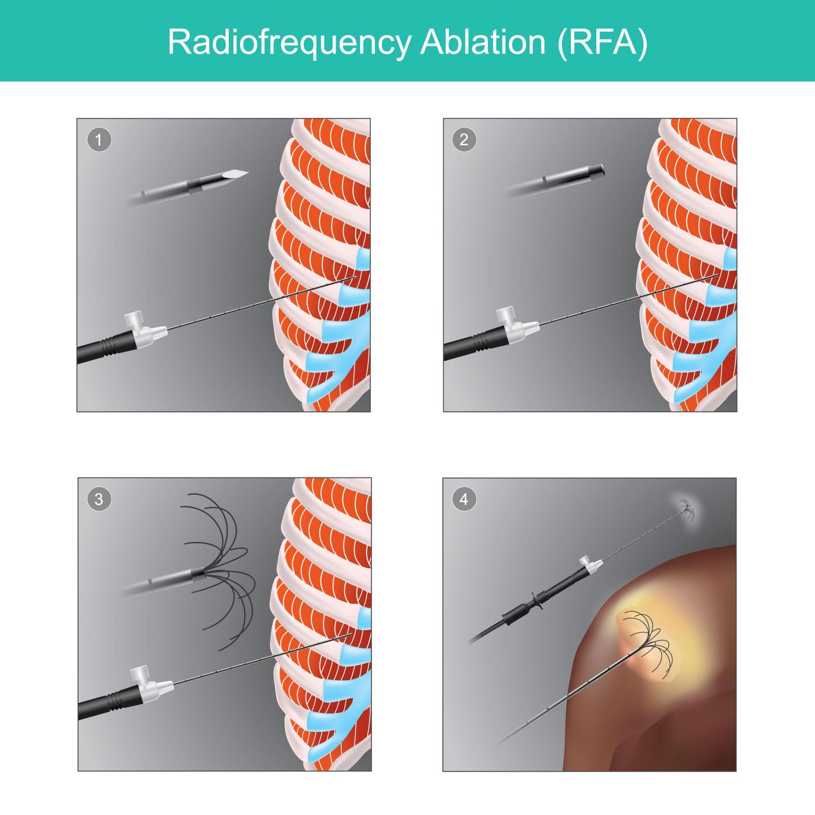 Gastrointestinal surgery Percutaneous gastrostomy feeding tube RFA Regal Hospital North Bangalore