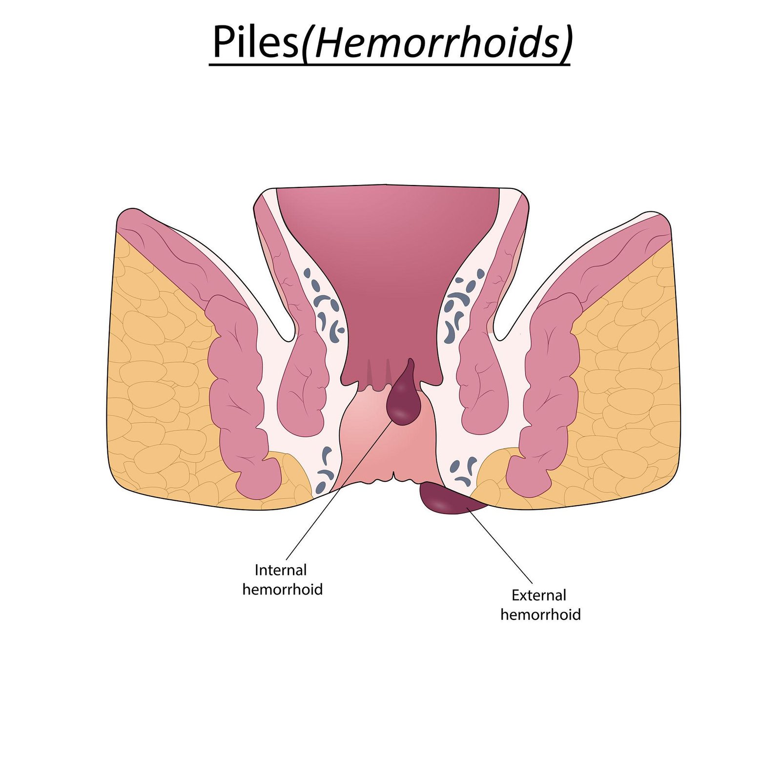 Gastrointestinal surgery Hemorrhoid piles treatment laser surgery Regal Hospital Bangalore