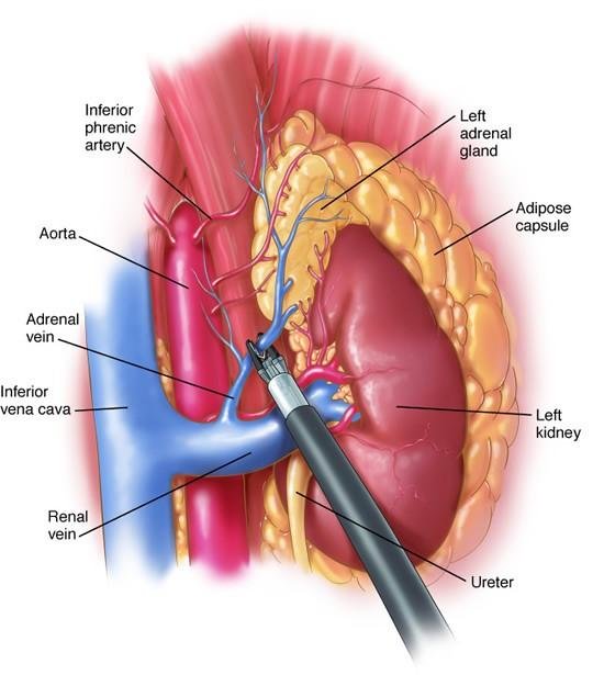 Adrenalectomy laparoscopic adrenal gland surgery Regal Hospital North Bangalore