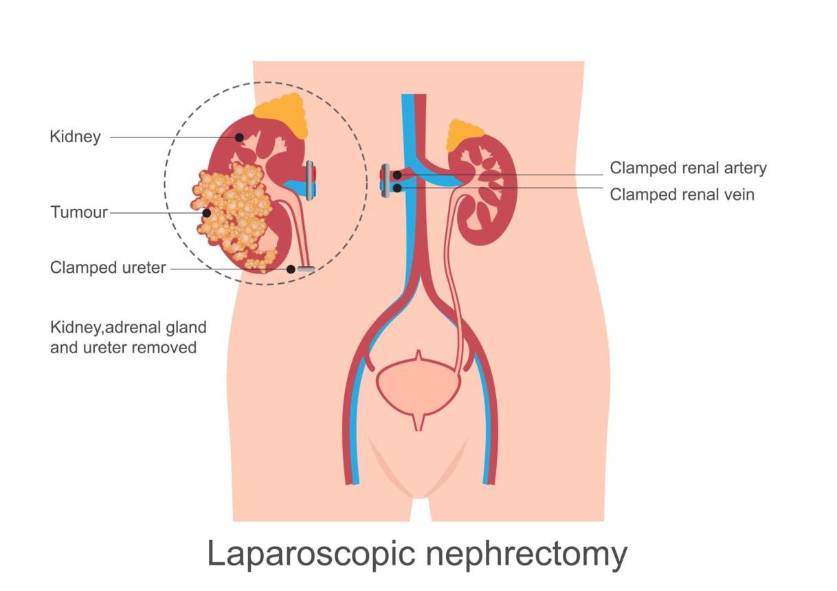 Laparoscopic nephrectomy kidney removal surgery Regal Hospital Bangalore
