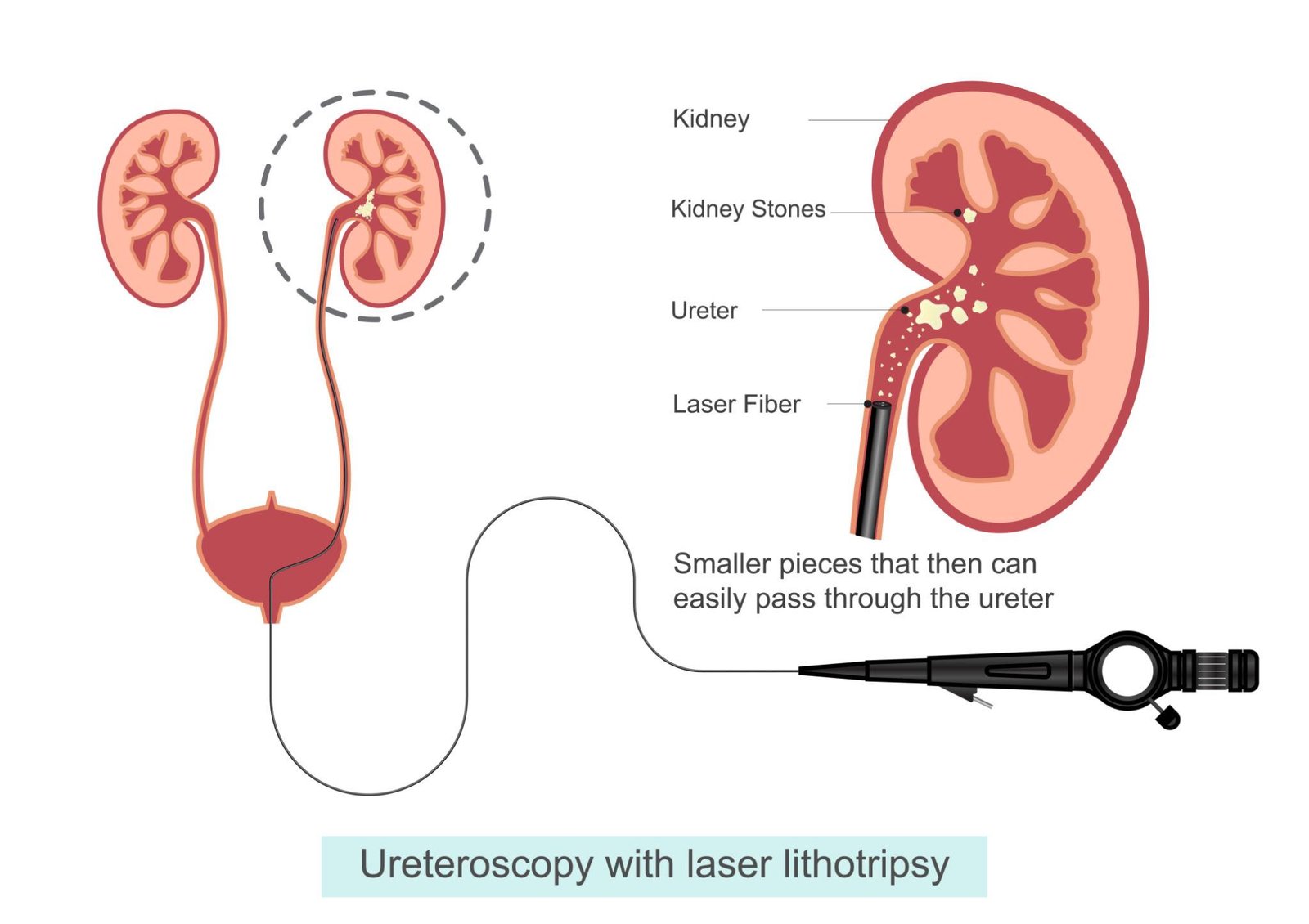 RIRS laser retrograde intrarenal surgery Regal Hospital North Bangalore