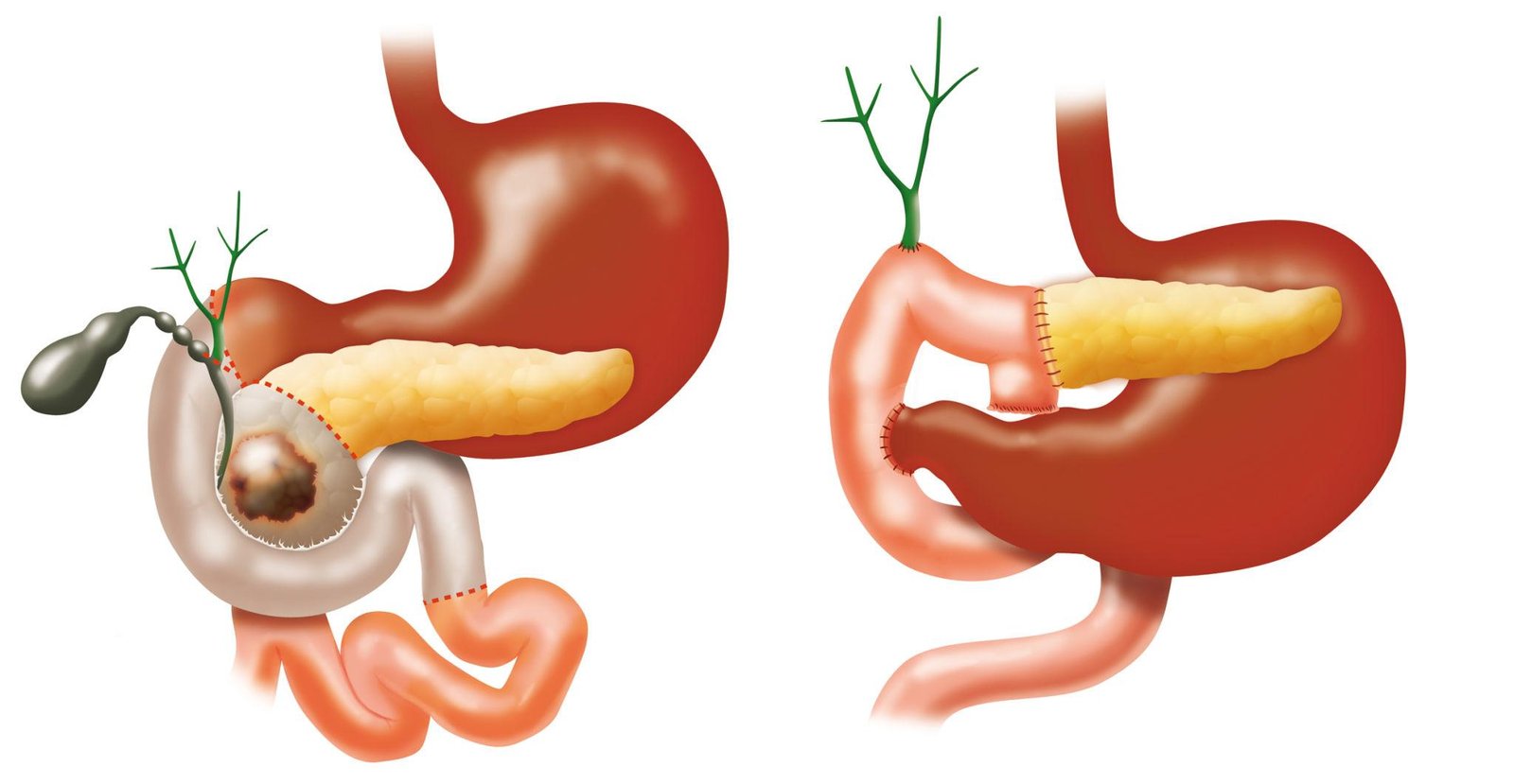 Gastrointestinal surgery Pancreatic surgery Whipple procedure Regal Hospital Bangalore