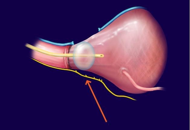 Prostate cancer surgery radical prostatectomy Regal Hospital North Bangalore
