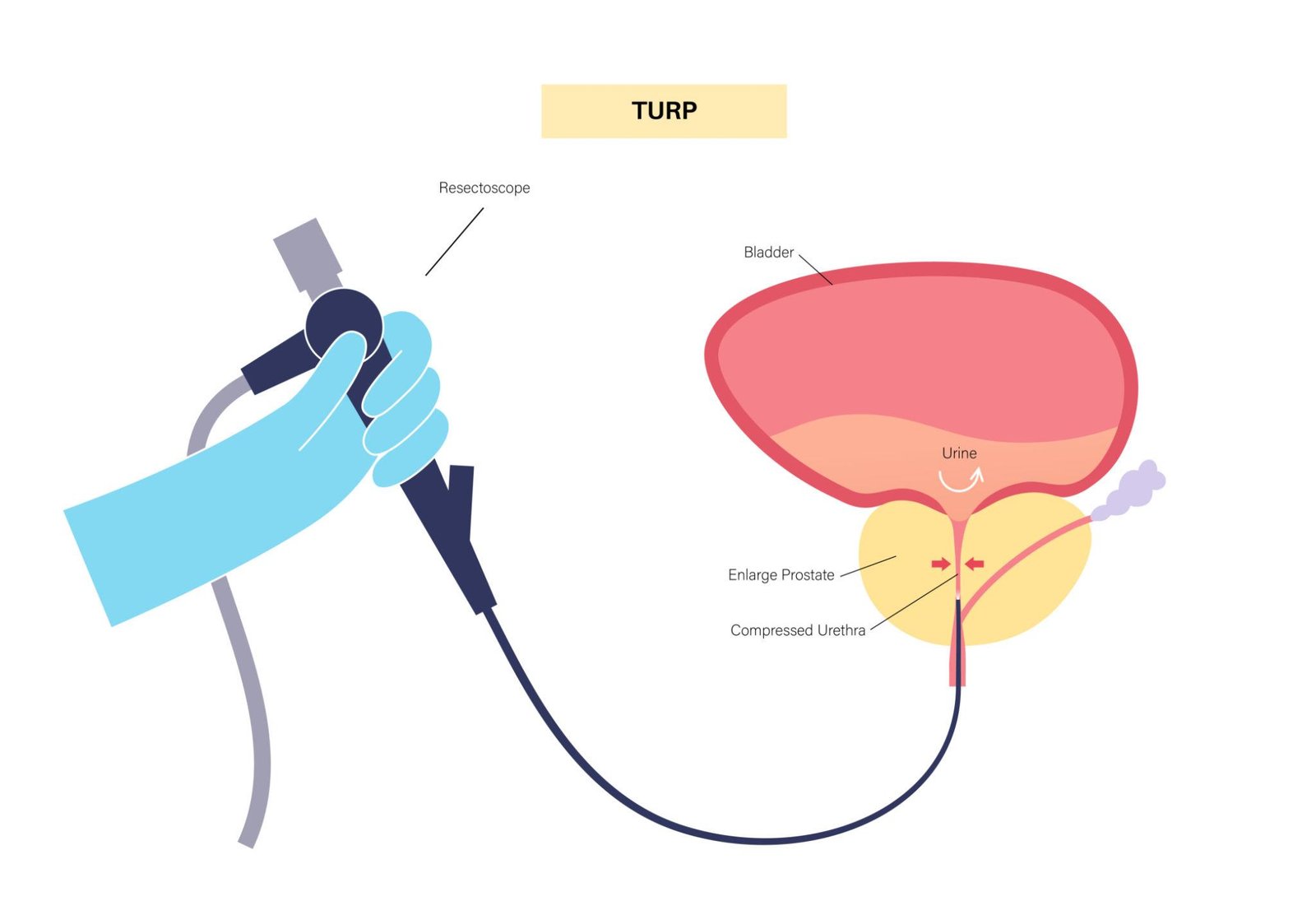 TURP transurethral resection prostate surgery Regal Hospital Bangalore
