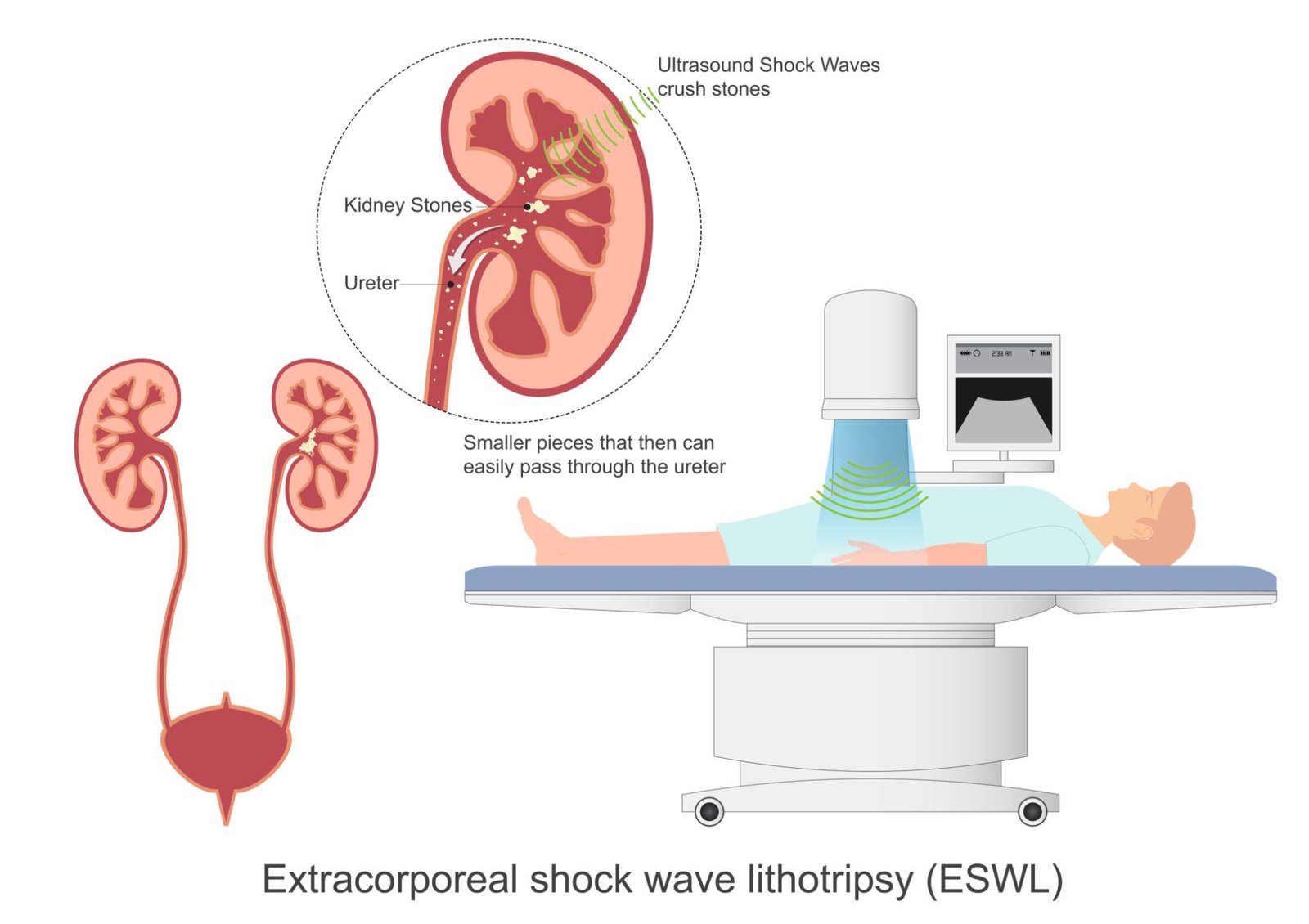 ESWL extracorporeal shock wave lithotripsy Regal Hospital North Bangalore