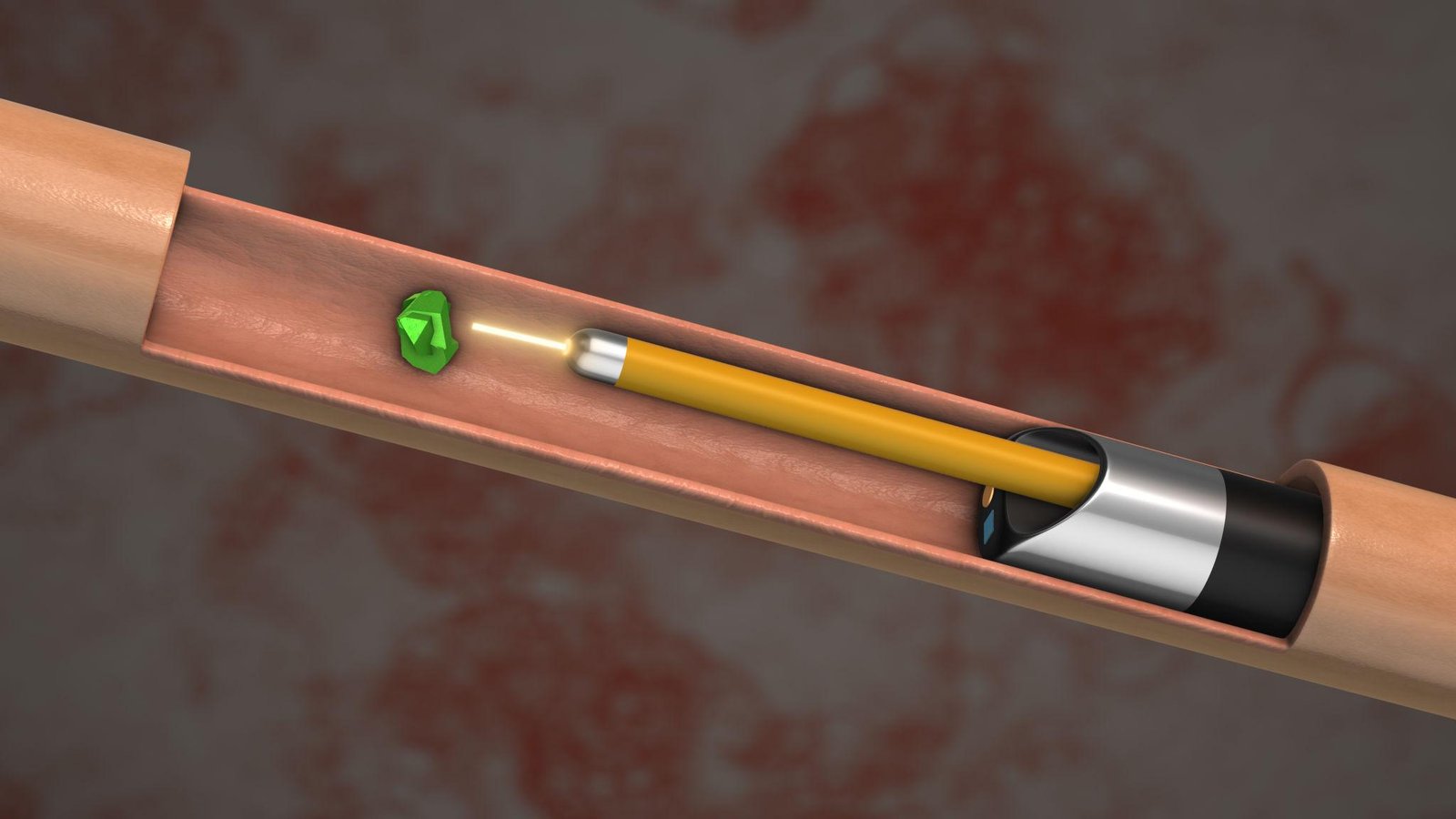 Ureteroscopy URS laser stone removal Regal Hospital Bangalore